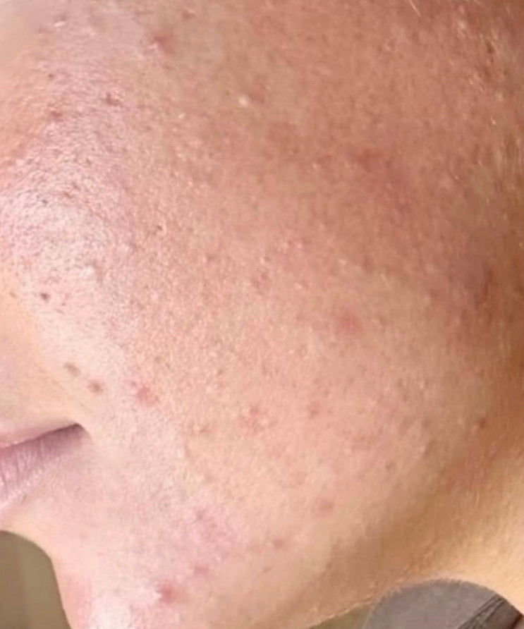 PURE SKIN Complex