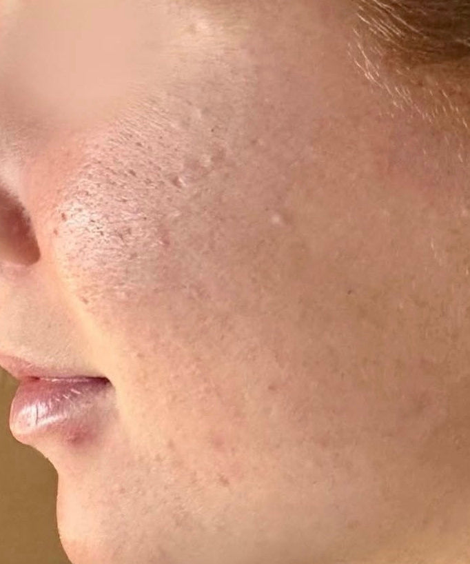 PURE SKIN Complex