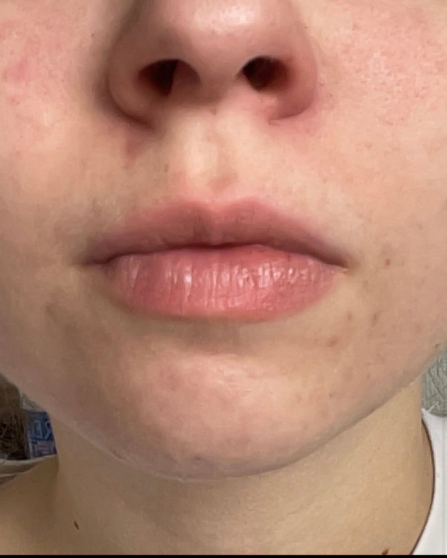 PURE SKIN Complex
