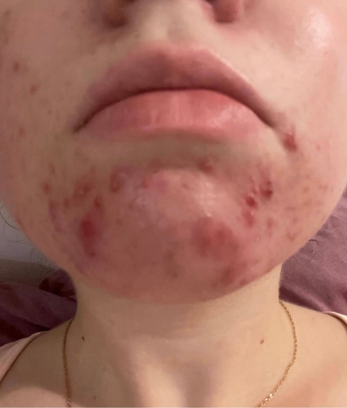 PURE SKIN Complex